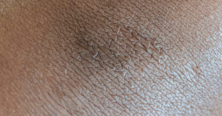 Textured background of skin surface with linear pattern and pigmentation spot in center